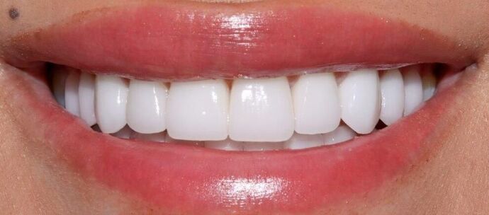 Smile Makeover & Veneers: Case 33 - After
