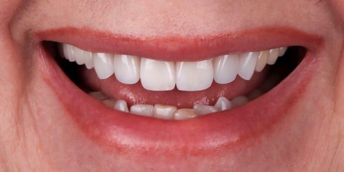 Smile Makeover & Veneers Rebecca