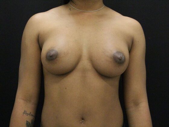 Breast Augmentation Case 23 - After