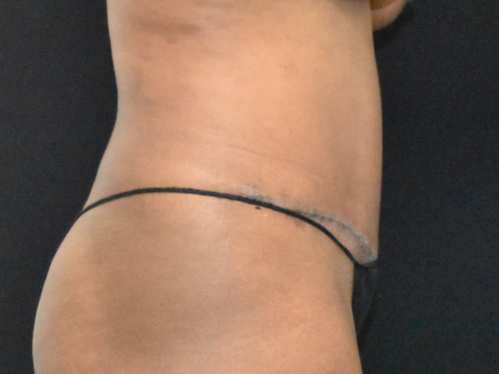 Abdominoplasty: Case 21 - After