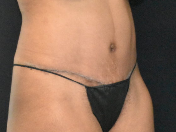 Abdominoplasty: Case 21 - After