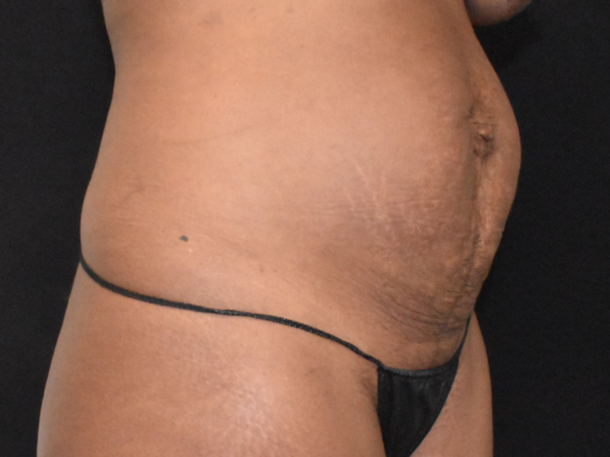 Abdominoplasty: Case 21 - Before