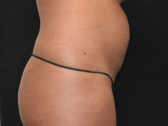 Abdominoplasty: Case 21 - Before