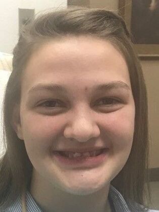 Dental Implants Case 3 - Before