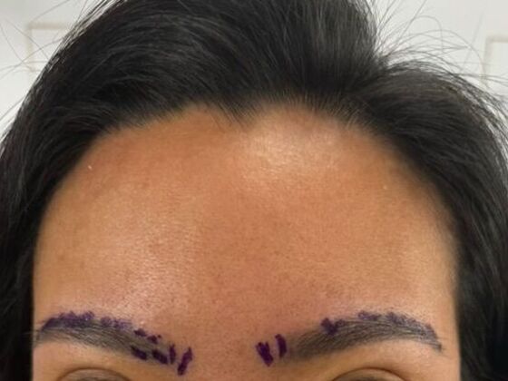 Eyebrow Transplantation: Case 5 - Before