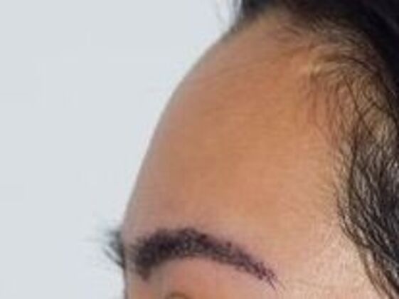 Eyebrow Transplantation: Case 5 - After