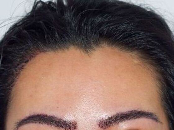 Eyebrow Transplantation: Case 5 - After