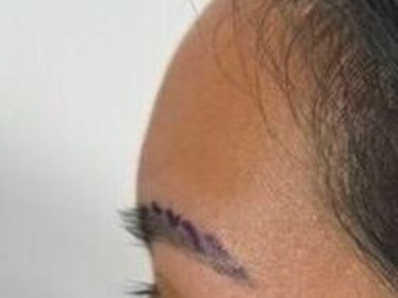 Eyebrow Transplantation: Case 5 - Before