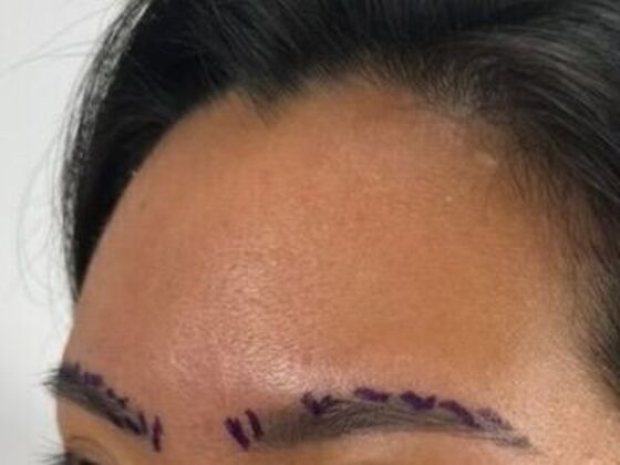 Eyebrow Transplantation: Case 5 - Before