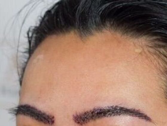 Eyebrow Transplantation: Case 5 - After