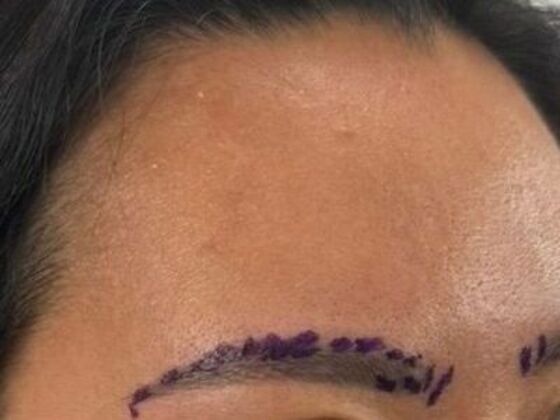 Eyebrow Transplantation: Case 5 - Before