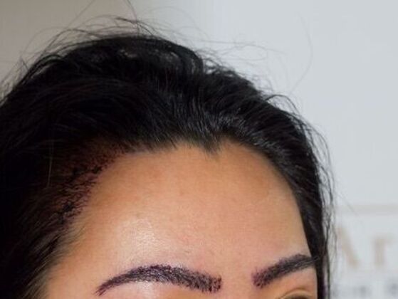 Eyebrow Transplantation: Case 5 - After