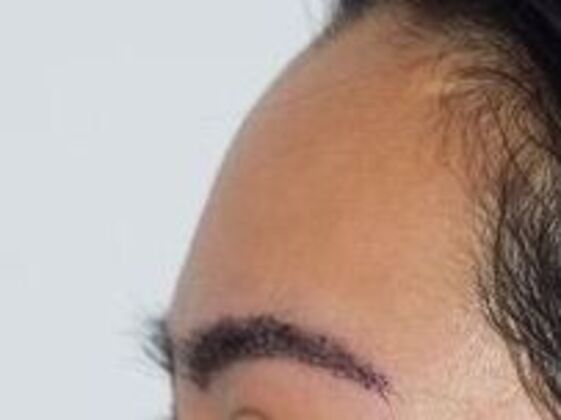 Long Hair FUE: Case 4 - After