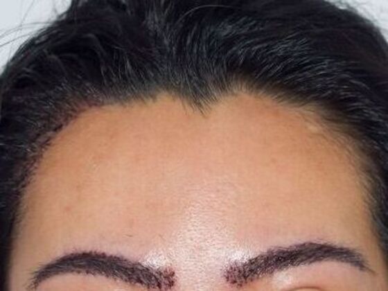 Long Hair FUE Case 4 - After