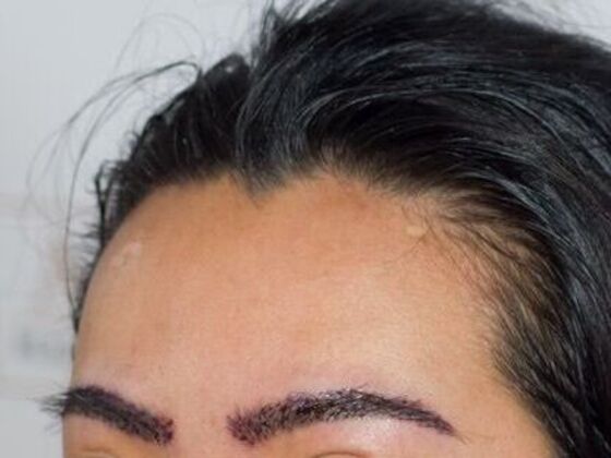 Long Hair FUE: Case 4 - After