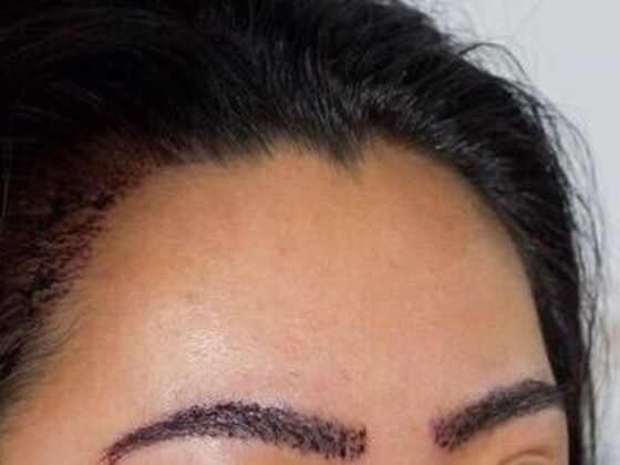 Long Hair FUE: Case 4 - After