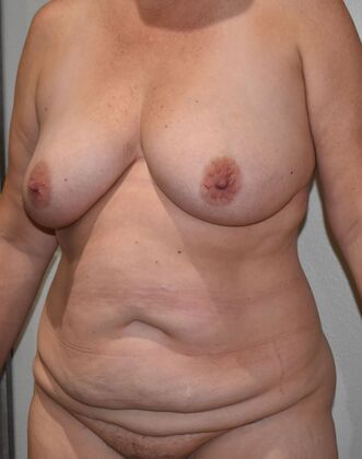 Mommy Makeover: Case 325 - Before