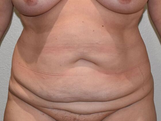 Tummy Tuck (Abdominoplasty): Case 512 - Before