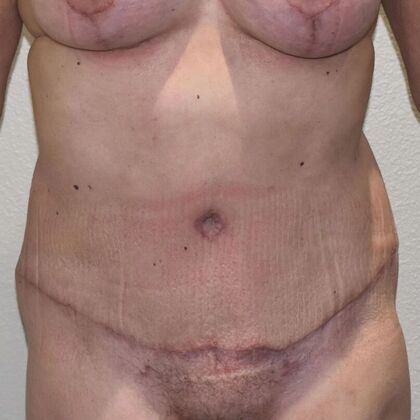 Tummy Tuck (Abdominoplasty): Case 513 - After