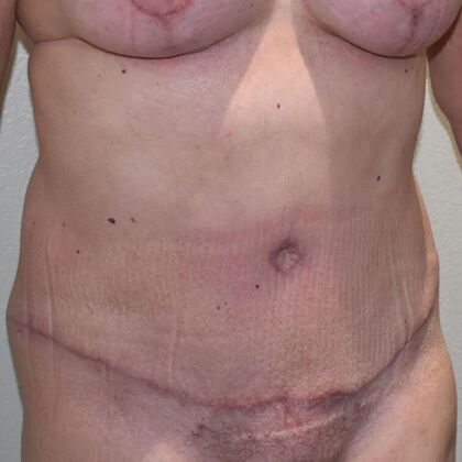 Tummy Tuck (Abdominoplasty): Case 513 - After