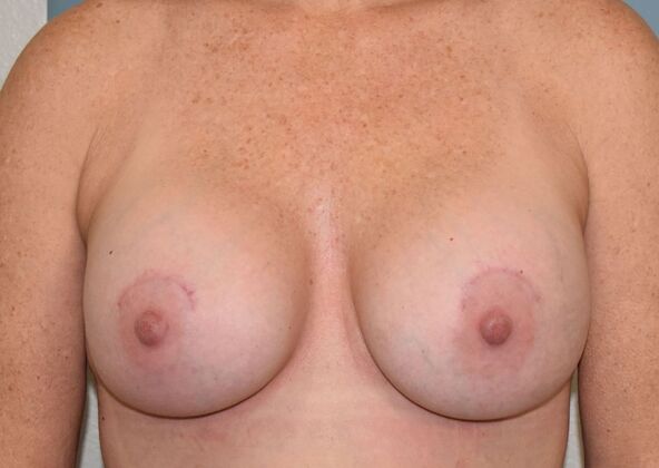Breast Augmentation Case 779 - After