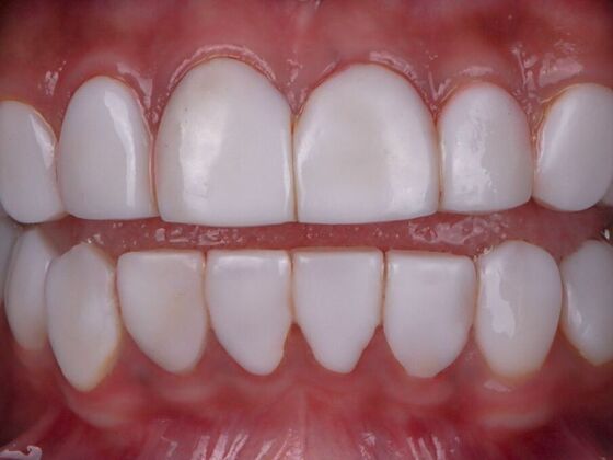 Smile Makeover & Veneers: Jessica - Before