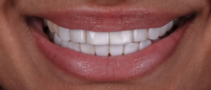 Smile Makeover & Veneers: Jessica - Before