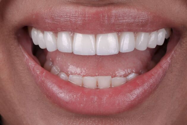 Smile Makeover & Veneers Jessica