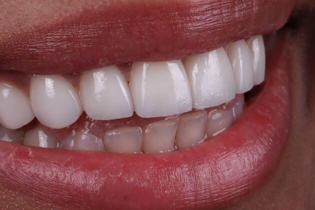 Smile Makeover & Veneers: Jessica - After