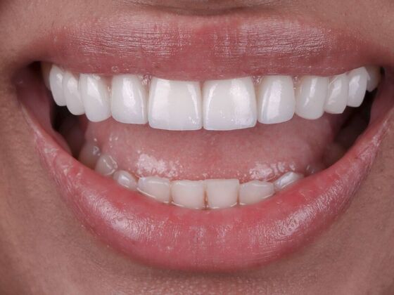 Smile Makeover & Veneers: Jessica - After