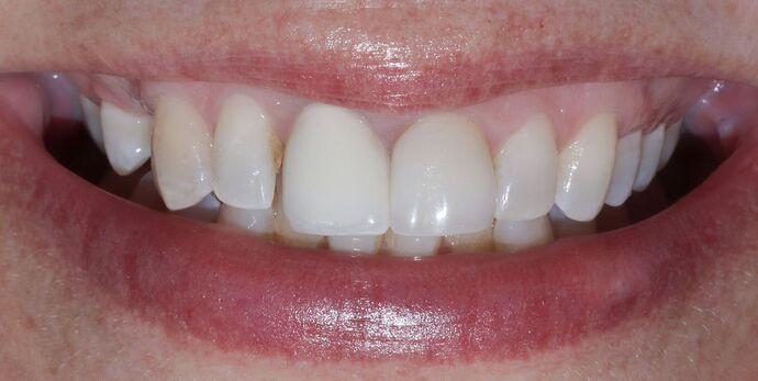 Smile Makeover & Veneers: Priscilla - Before