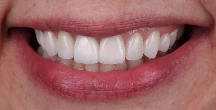 Smile Makeover & Veneers: Priscilla - After