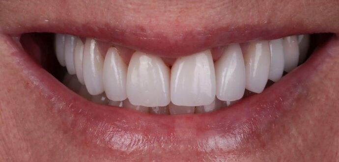 Smile Makeover & Veneers: Tiffany - After