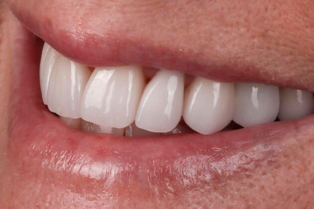 Smile Makeover & Veneers Tiffany