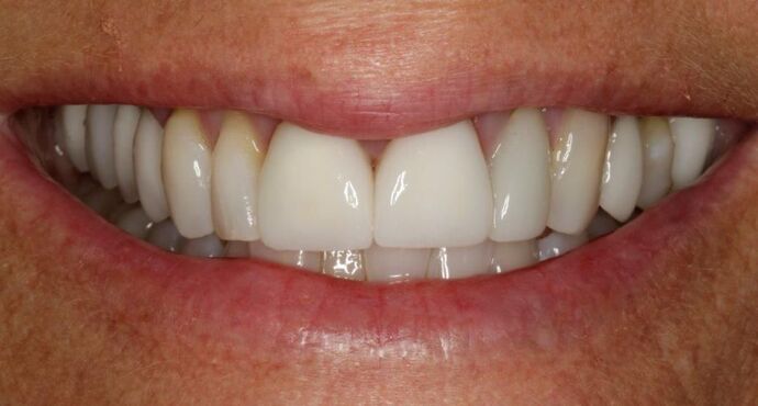 Smile Makeover & Veneers: Tiffany - Before