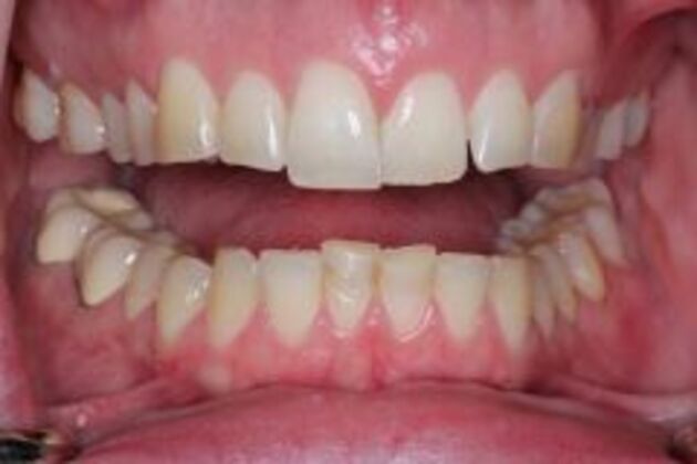 Invisalign Case 1 - Before