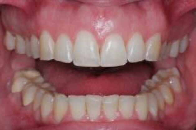 Invisalign Cases