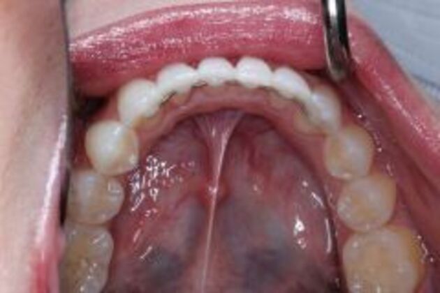 Invisalign Case 2 - After