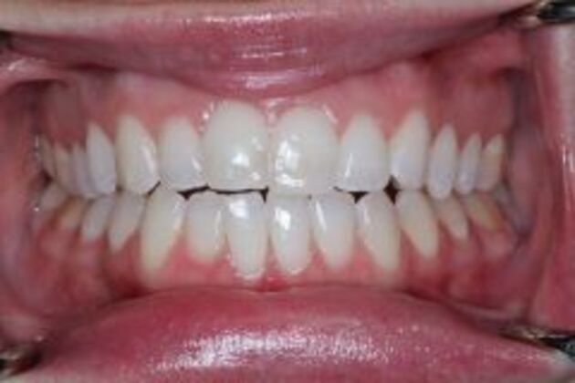 Invisalign Case 2 - Before