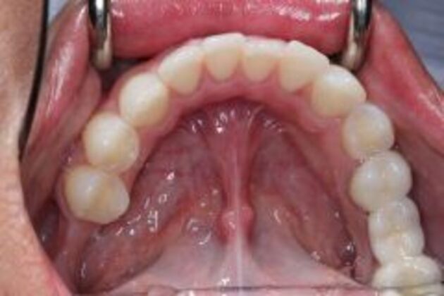 Invisalign Case 3 - Before