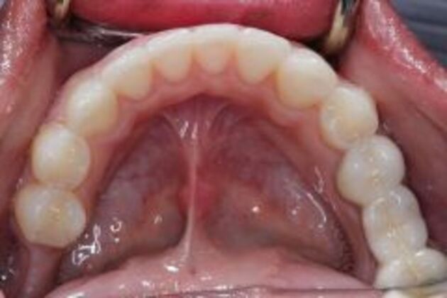 Invisalign Case 3 - After