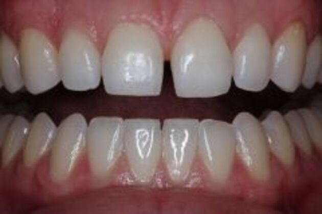 Invisalign Case 4 - Before