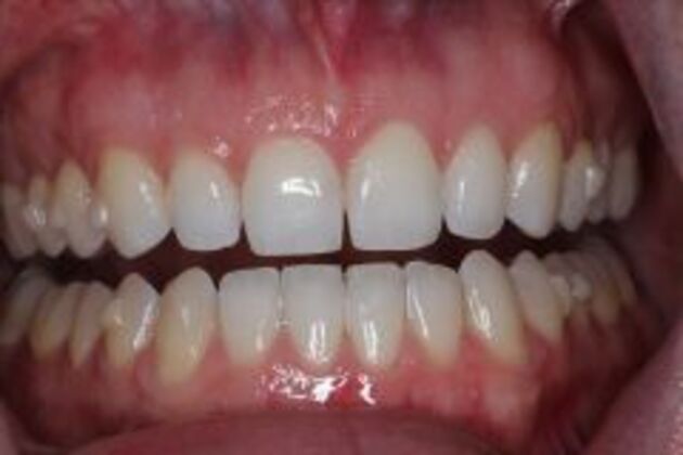 Invisalign Case 4 - After