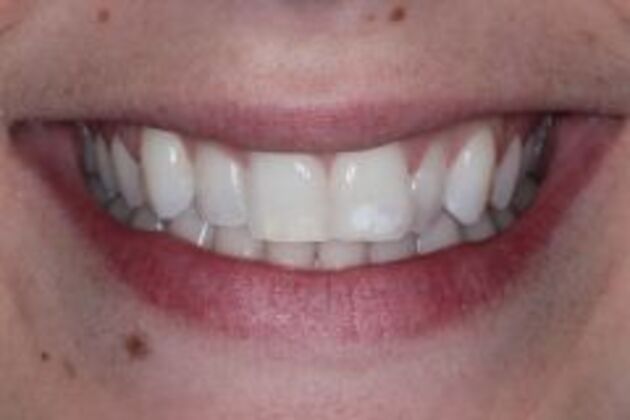 Invisalign Case 5 - Before