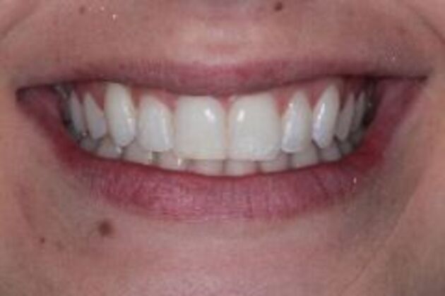 Invisalign Case 5 - After