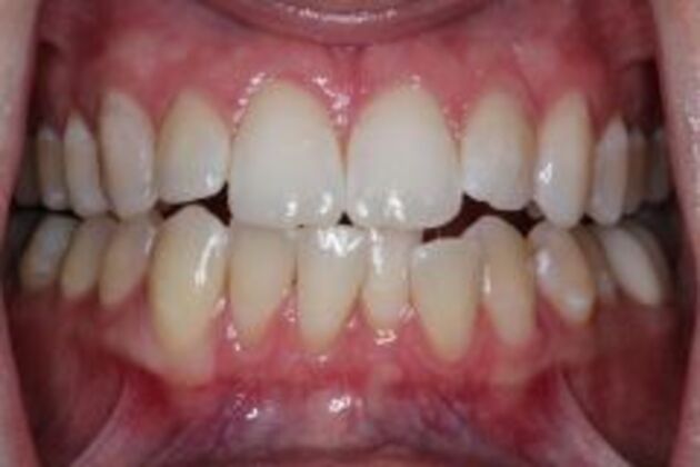 Invisalign Case 6 - Before