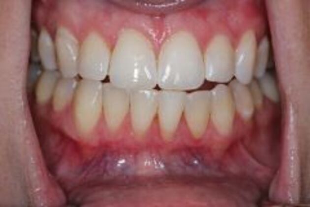 Invisalign Case 6 - After