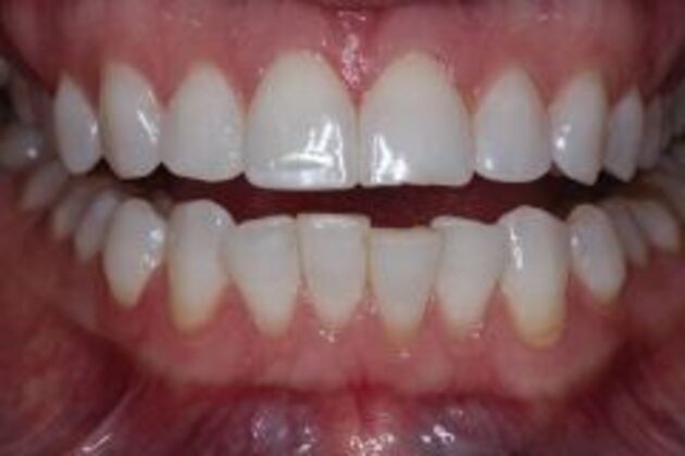 Invisalign Case 7 - Before
