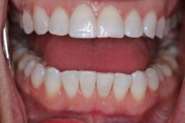 Invisalign Case 7 - After