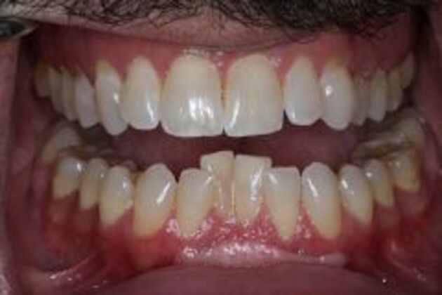 Invisalign Case 8 - Before